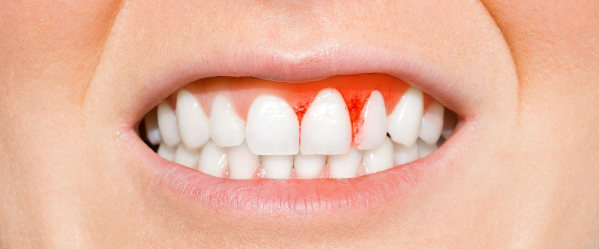 A Woman's teeth with bleeding gums