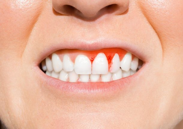 A Woman's teeth with bleeding gums