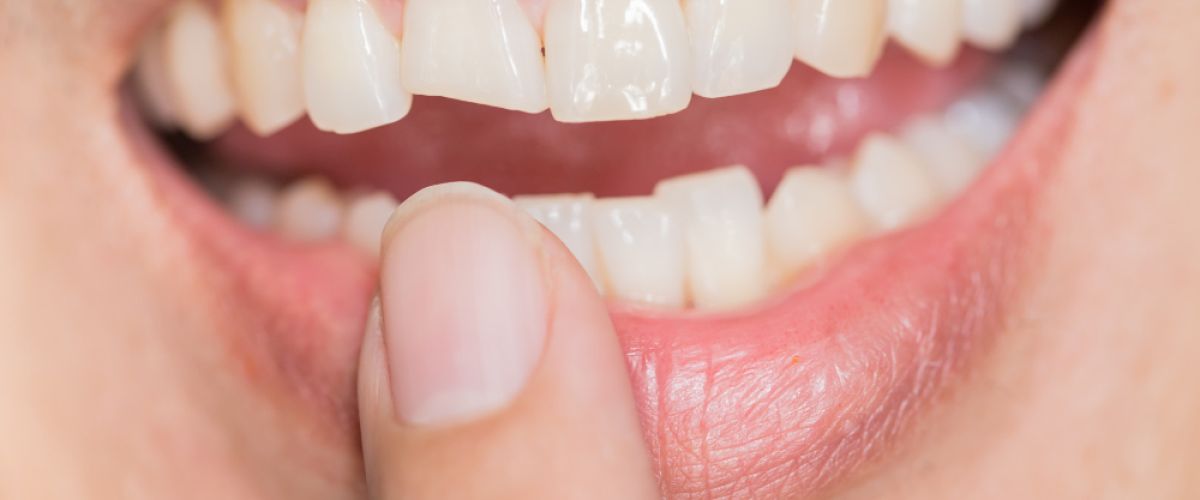 A woman pointing to her mouth showing a chipped tooth