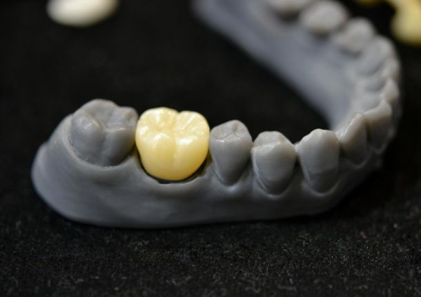 dental crown on a grey jaw cast