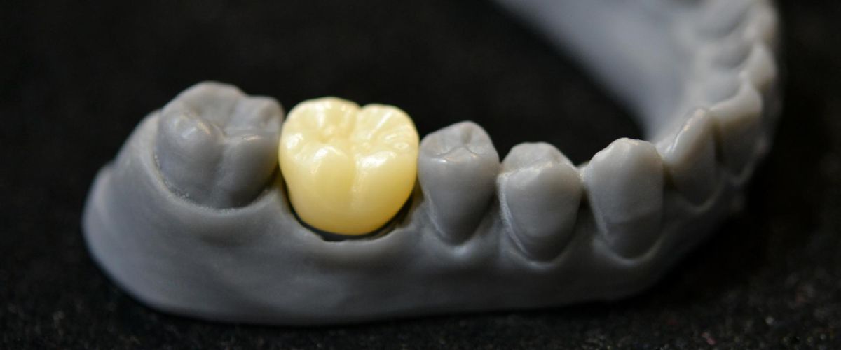 dental crown on a grey jaw cast